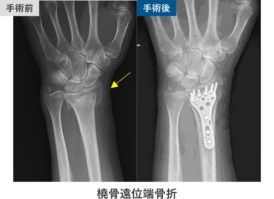 橈骨遠位端骨折