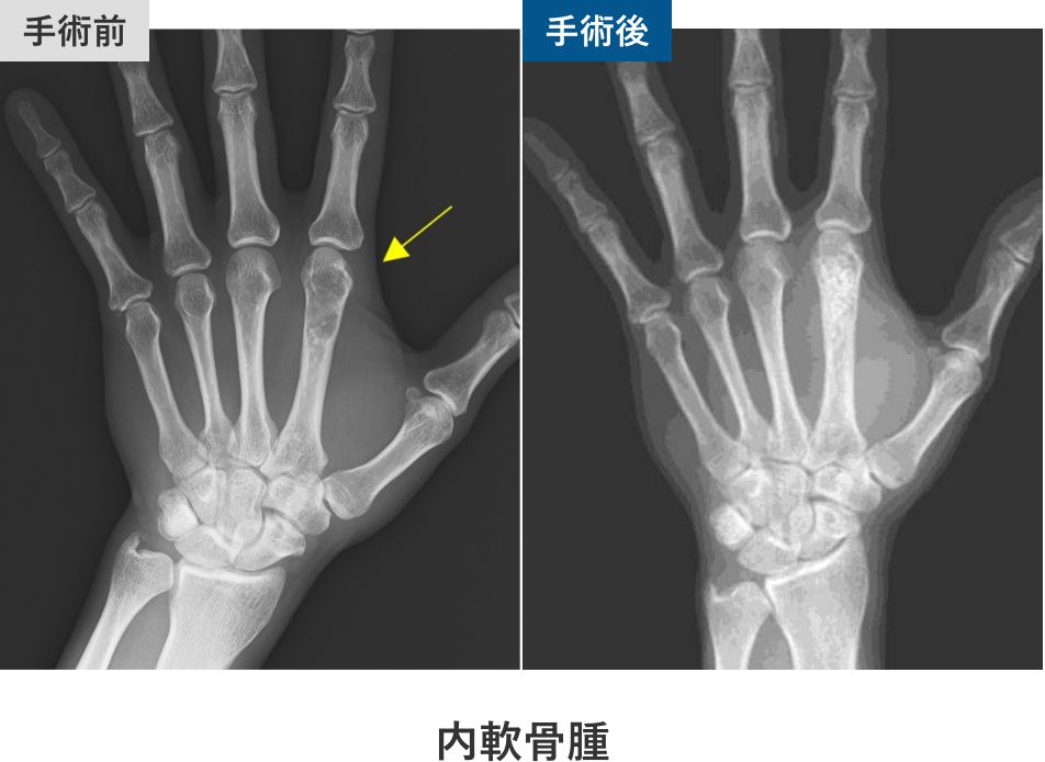 内軟骨腫