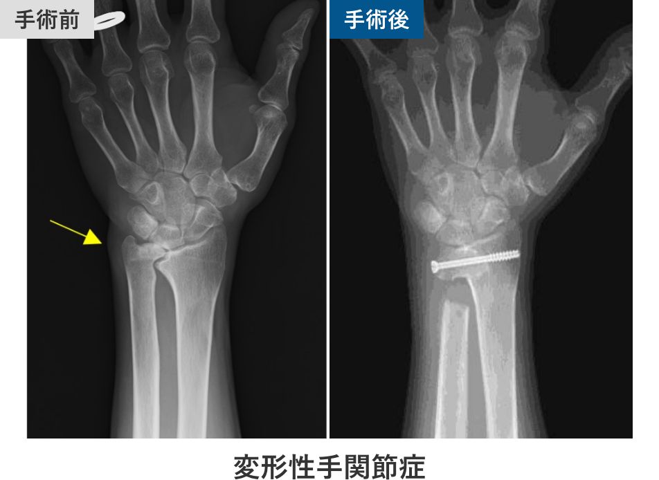 変形性手関節症