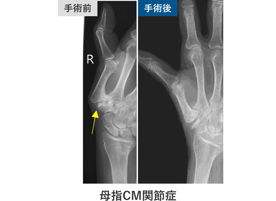 母指CM関節症