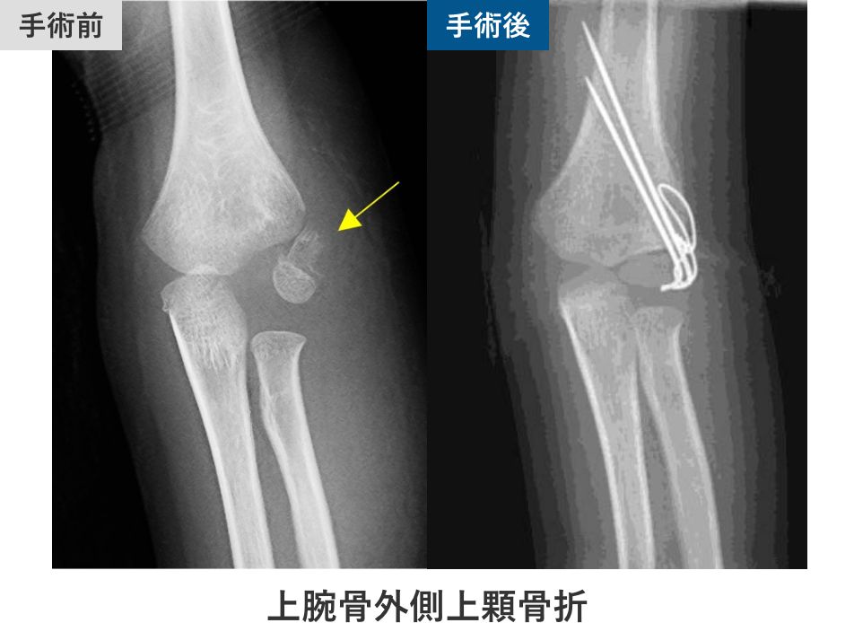 上腕骨外側上顆骨折