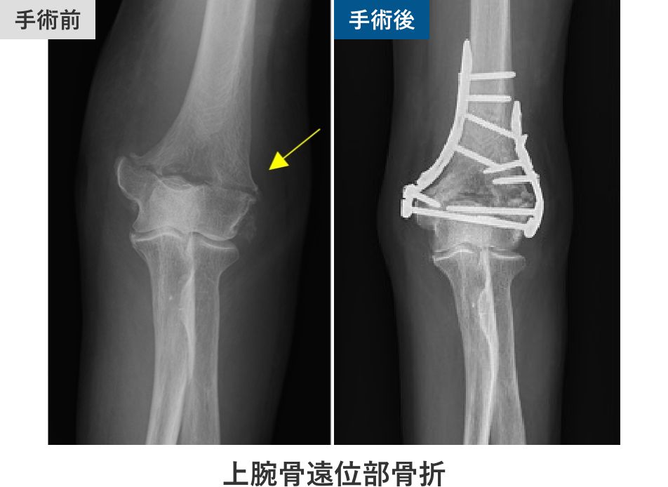 上腕骨遠位部骨折
