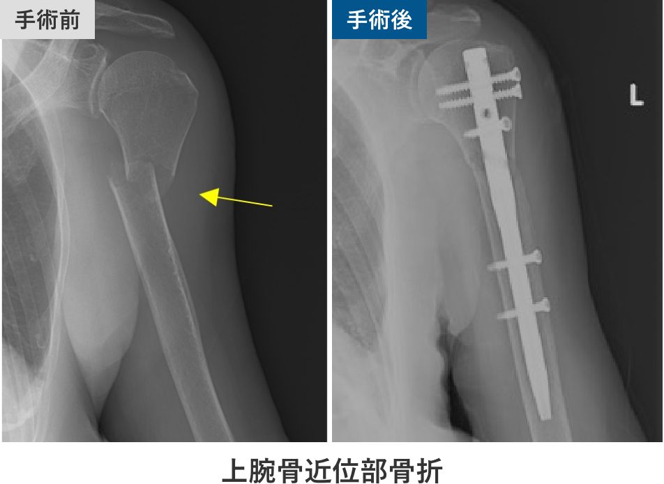 上腕骨近位部骨折